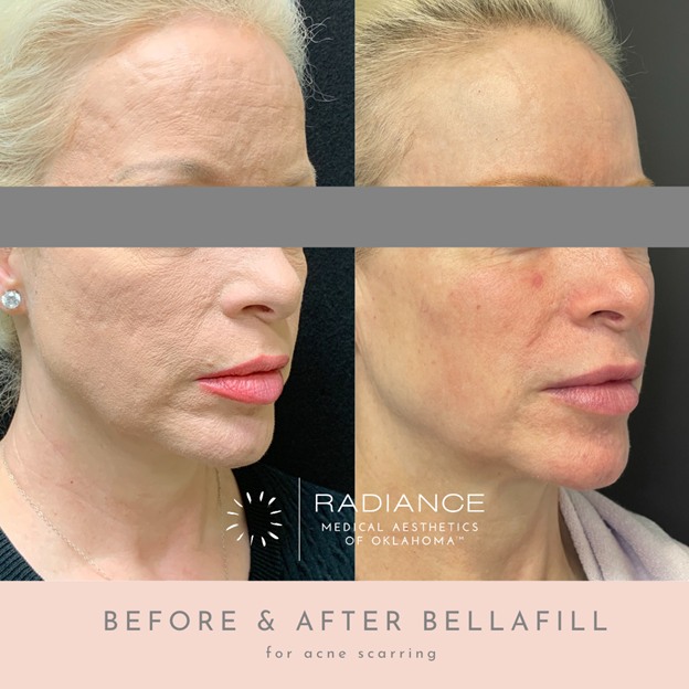 Before & After results of bellafill procedure at OKC Med Spa