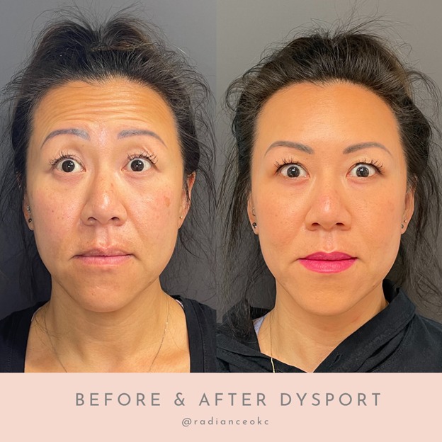 Dysport treatment helps to reduce fine lines and wrinkles in Oklahoma City, OK.