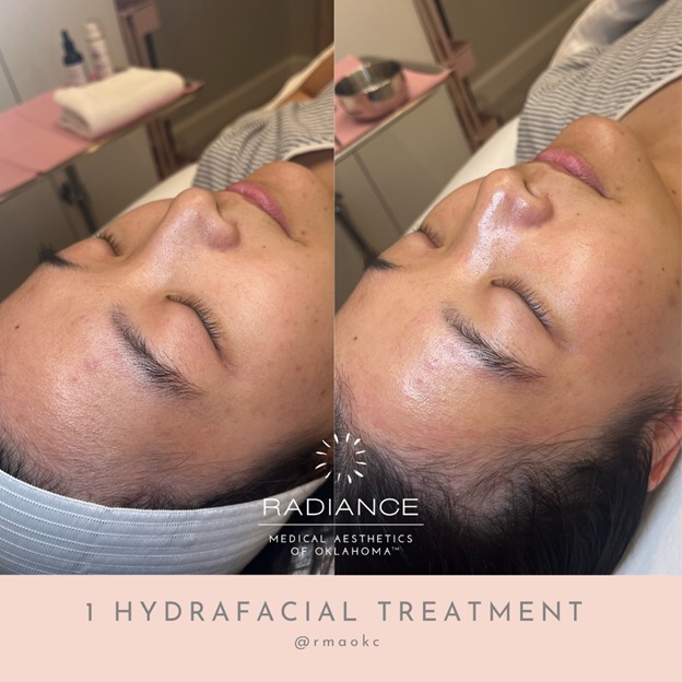 HydraFacial treatment for a radiant glow skin in Oklahoma City, OK.