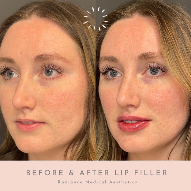 Before & After Result of lip filler procedure at Med Spa OKC