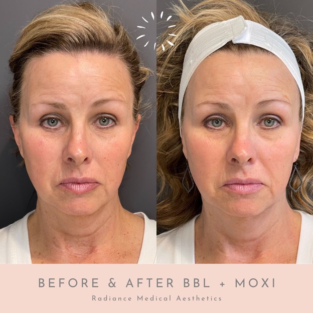 Moxi and BBL treatment to improve skin tone and texture in Oklahoma City, OK.