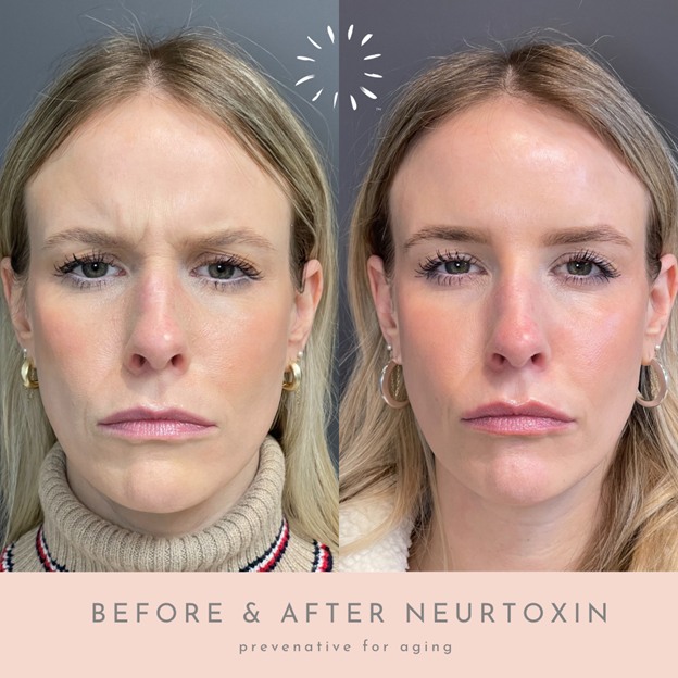 Neurotoxin treatments to achieve a refreshed and youthful appearance in Oklahoma City, OK.