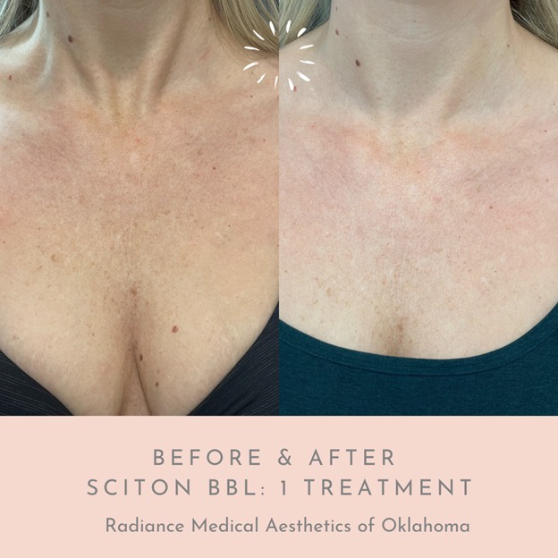 Sciton BBL treatment, offering advanced skin rejuvenation in Oklahoma City, OK.