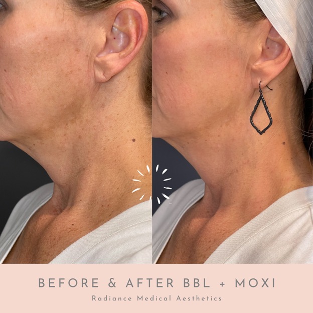BBL and Moxi combination treatment at Radiance Medical Aesthetics of Oklahoma in Oklahoma City, OK.