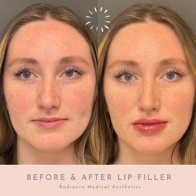Before and after lip filler treatment at Radiance Medical Aesthetics of Oklahoma in Oklahoma City.