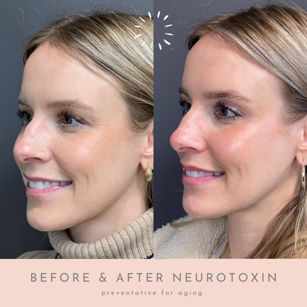 Before and after neurotoxin injections in Oklahoma City, with a visible reduction in facial wrinkles.