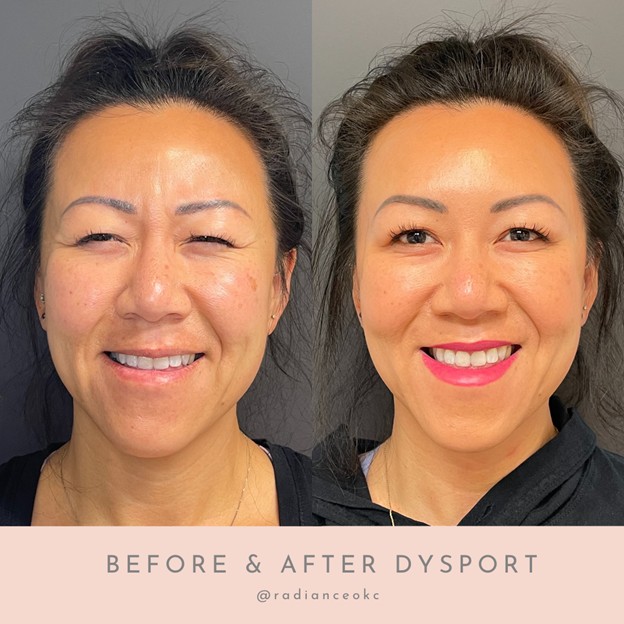 Dysport before and after results at Radiance Medical Aesthetics of Oklahoma in Oklahoma City, OK.