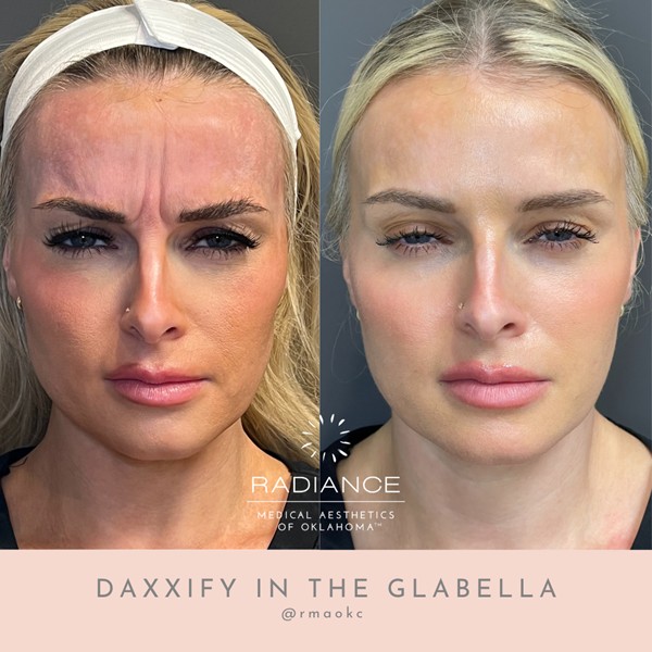 Glabella Daxxify treatment at Radiance Medical Aesthetics of Oklahoma in Oklahoma City, OK.