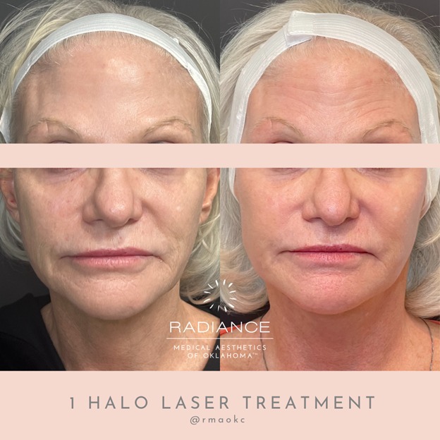 Halo laser skin resurfacing before and after results in Oklahoma City, revealing healthier skin.