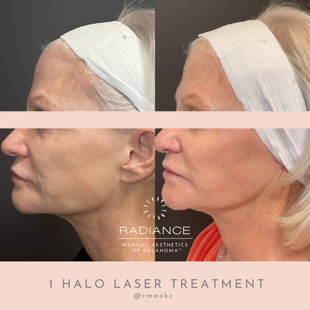 Before & After the Halo treatment procedure at OKC Med Spa
