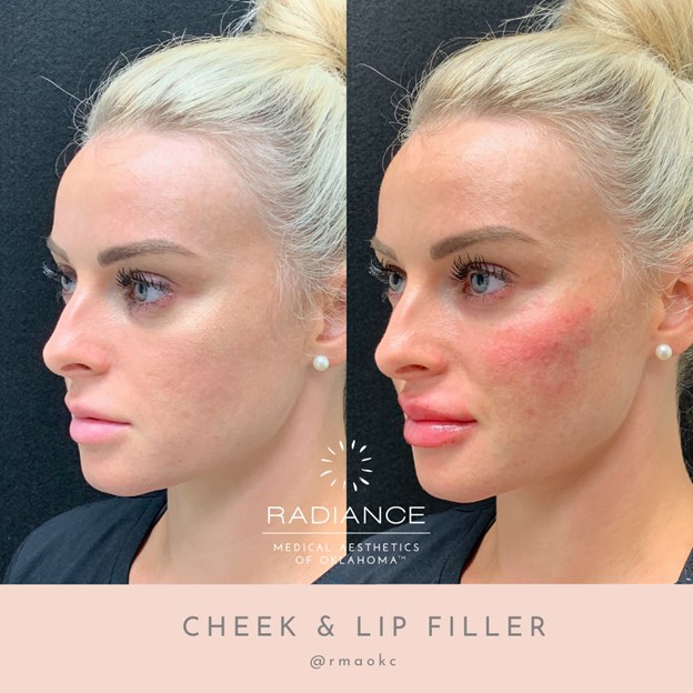 Lip and cheek filler treatment, enhancing facial contours in Oklahoma City, OK.