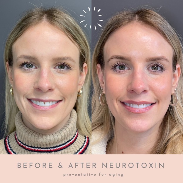 Oklahoma City neurotoxin treatment results show a smoother forehead and reduced lines.