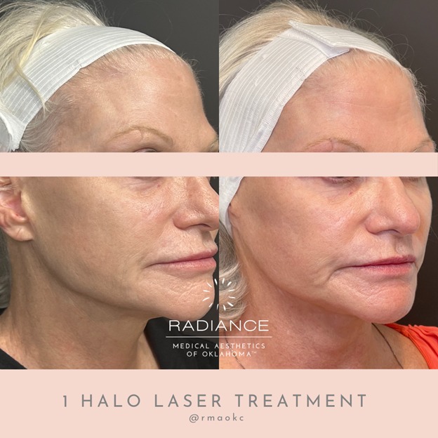Halo laser treatment results at Radiance Medical Aesthetics of Oklahoma in Oklahoma City, OK.