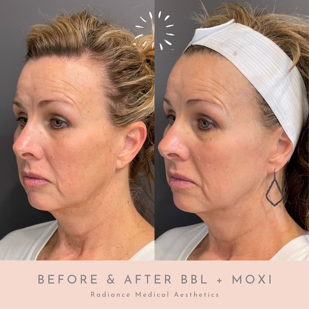 Before and after results of BBL and Moxi treatments with transformative skincare in Oklahoma City.