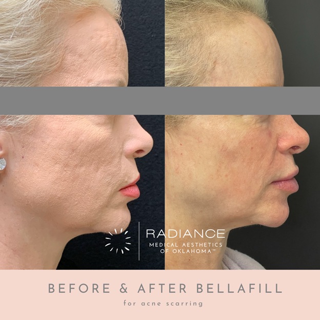 Bellafill filler treatment results before and after in Oklahoma City to restore facial volume.