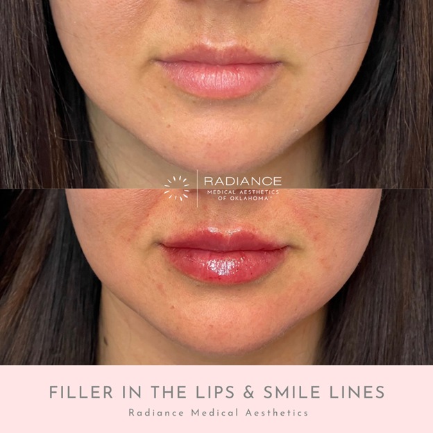 Lip and smile line fillers to enhance natural beauty in Oklahoma City, OK.