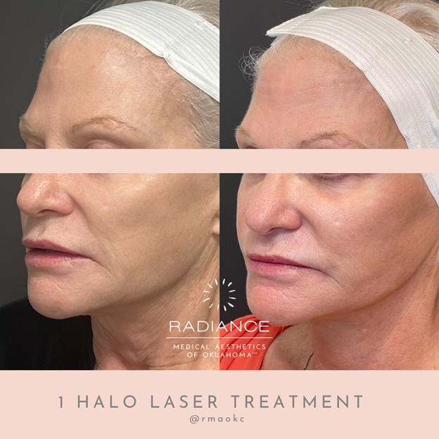 Halo laser treatment's Before and after results, improving skin texture in Oklahoma City, OK.