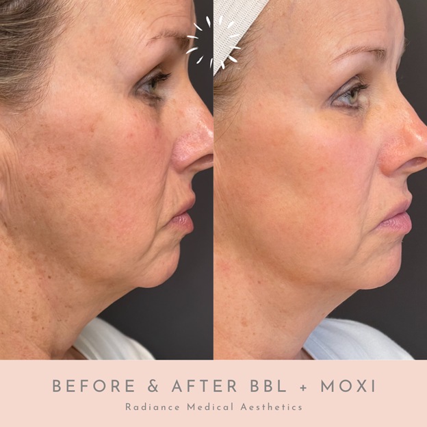 Oklahoma City BBL and Moxi laser skin rejuvenation results before and after.