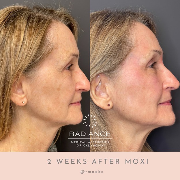 Before and after Moxi treatment, revealing brighter and more even skin in Oklahoma City, OK.