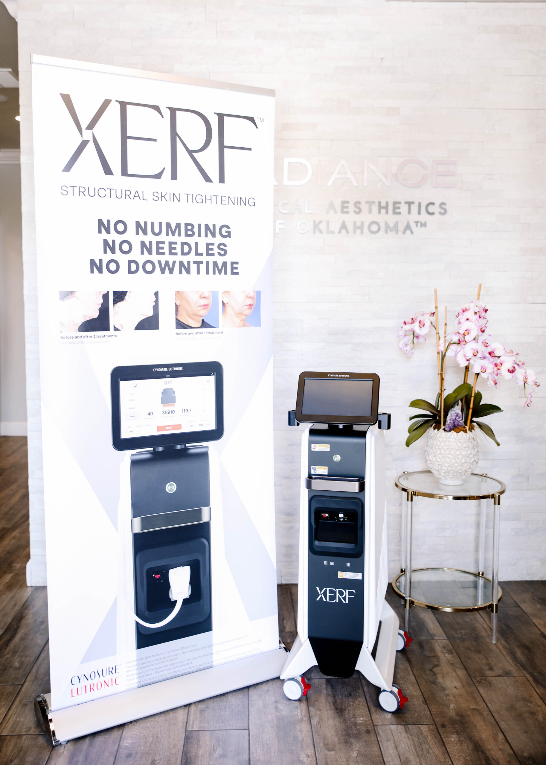 The patient is happy with the nanolaser peel results at RMAOK in Oklahoma City