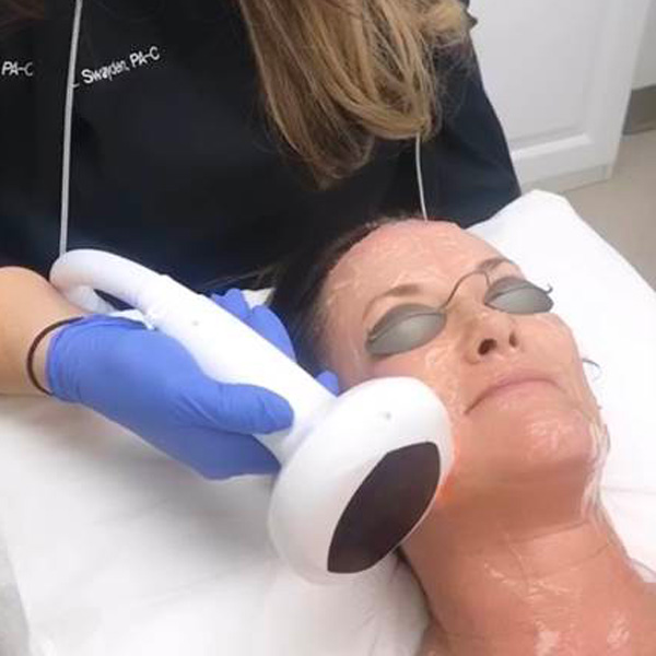 IPL procedure