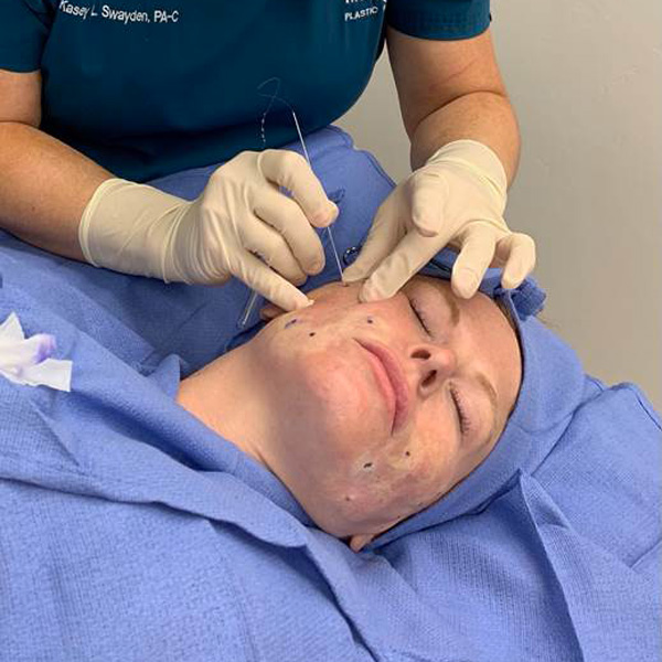 Instalift treatment