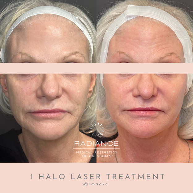 1 halo laser treatment