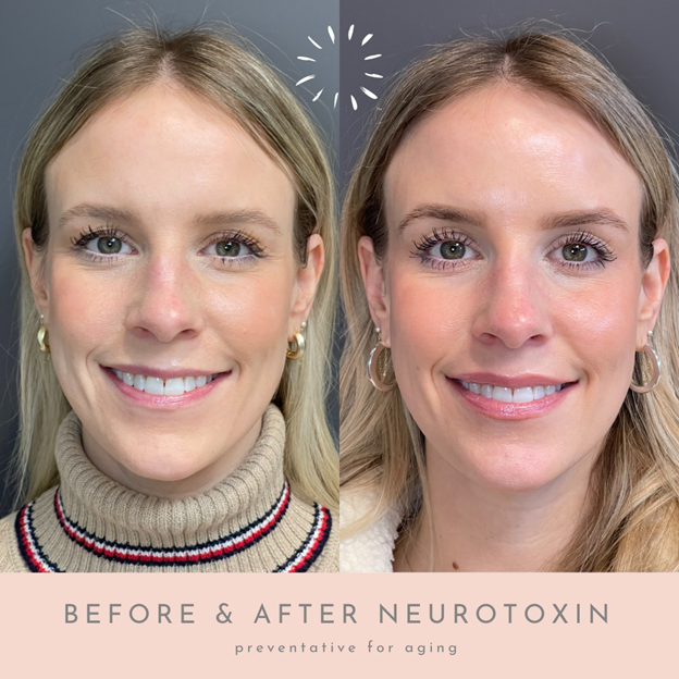 Before & After Neurotoxin