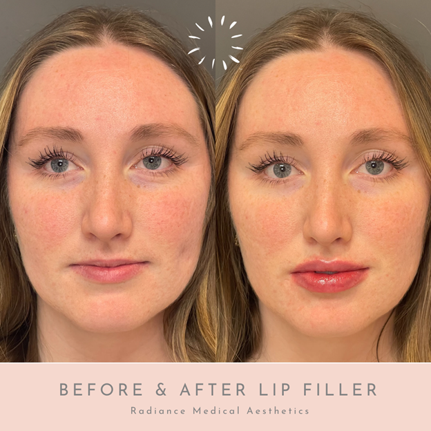 before & after lip filler