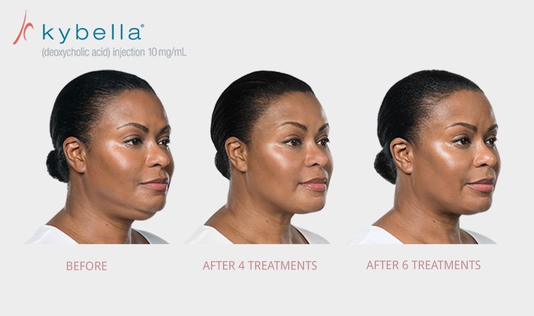 Before & After Kybella treatment offered at Med Spa OKC