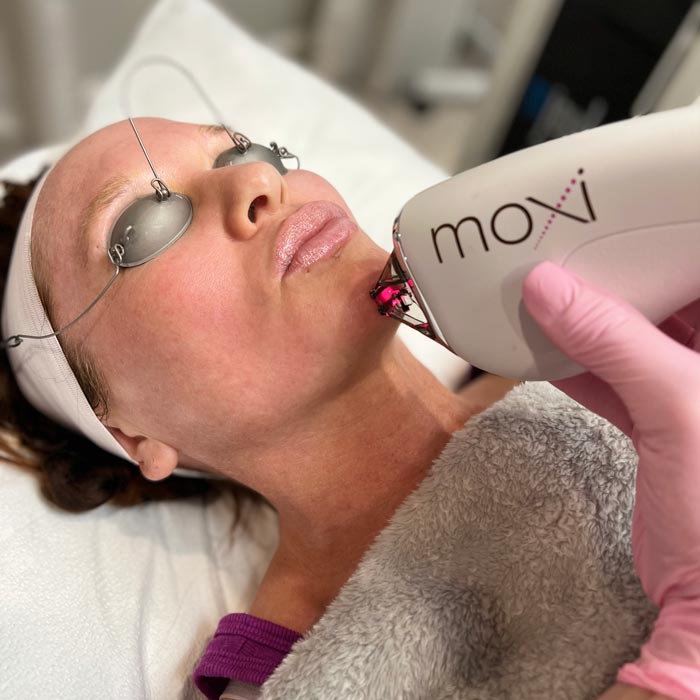 Moxi treatment being performed for a client at OKC Med Spa